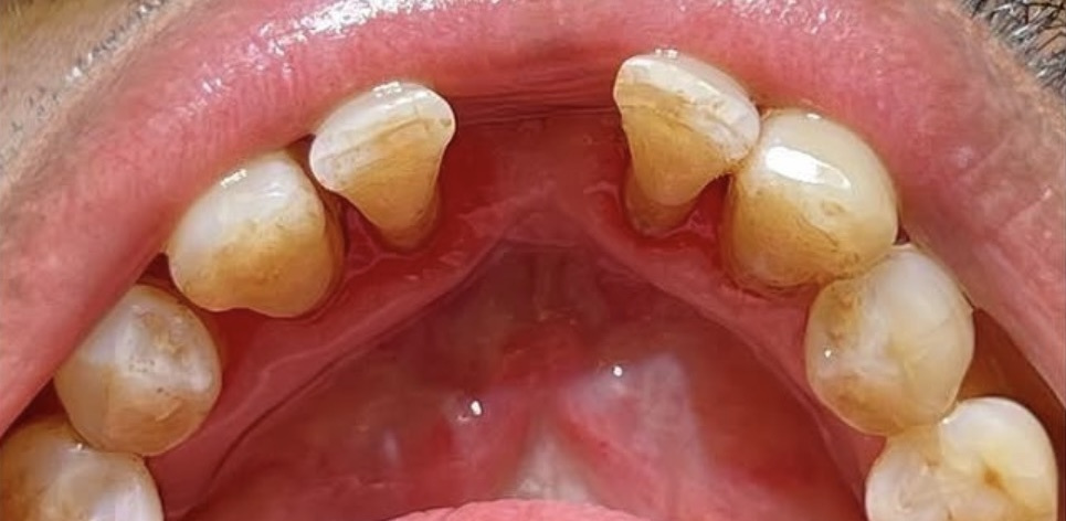 Dental cleaning after treatment