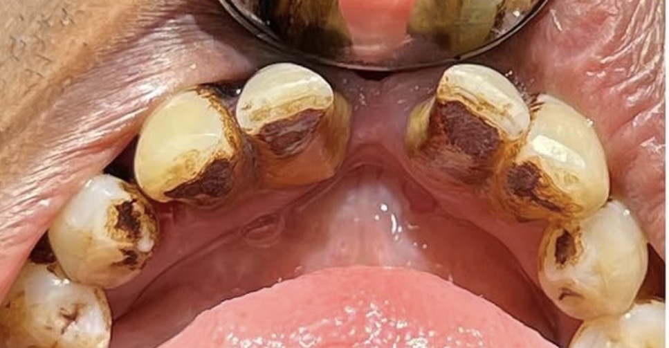 Dental cleaning before treatment