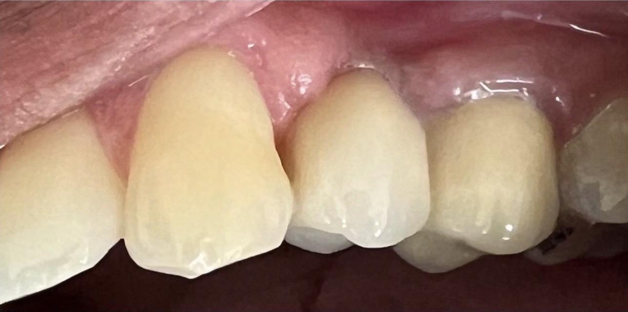 Crowns and bridges after treatment