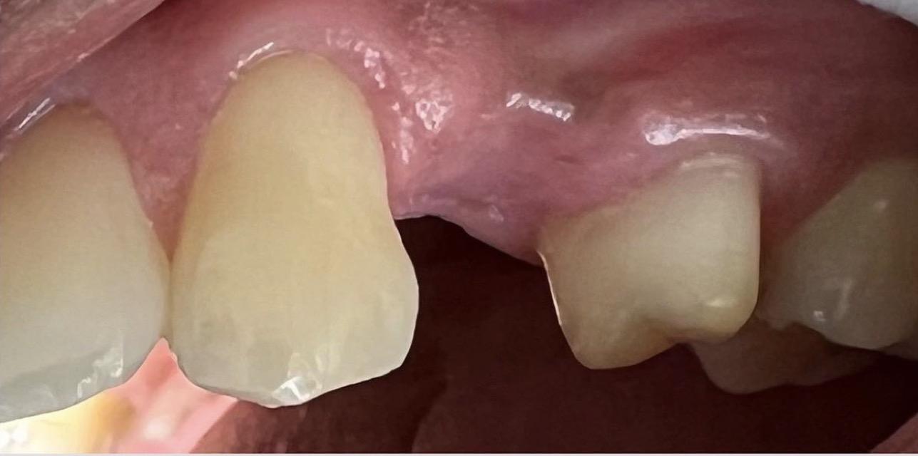 Crowns and bridges before treatment