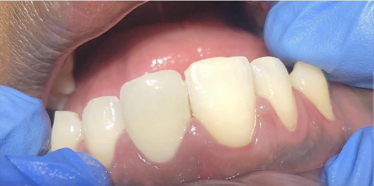 Dental fillings after treatment