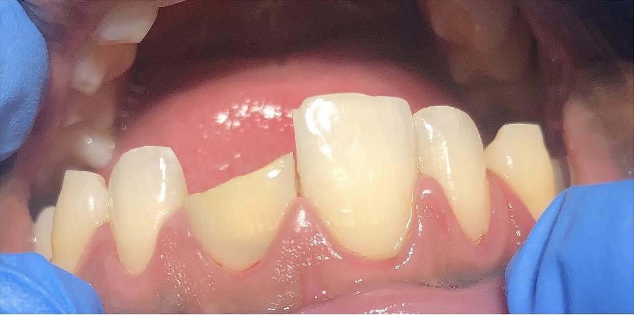 Dental fillings before treatment