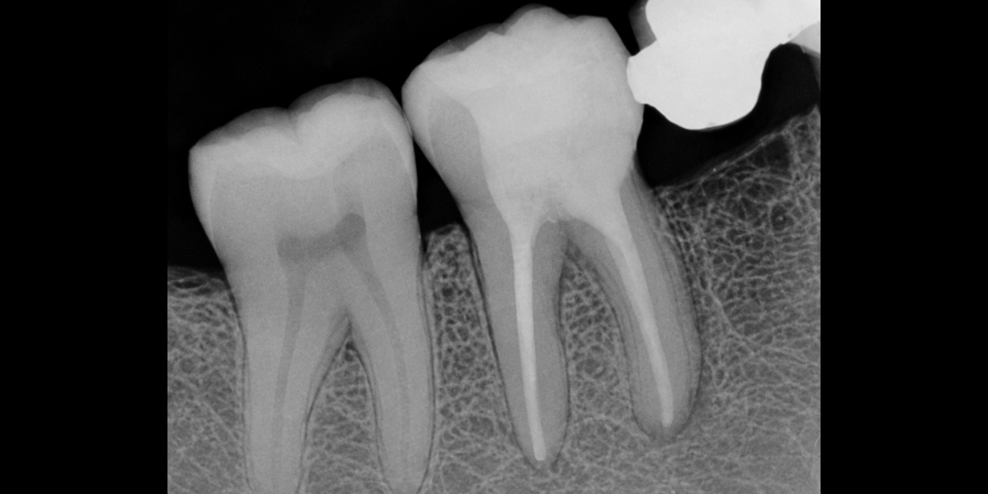 Root canal treatment after treatment