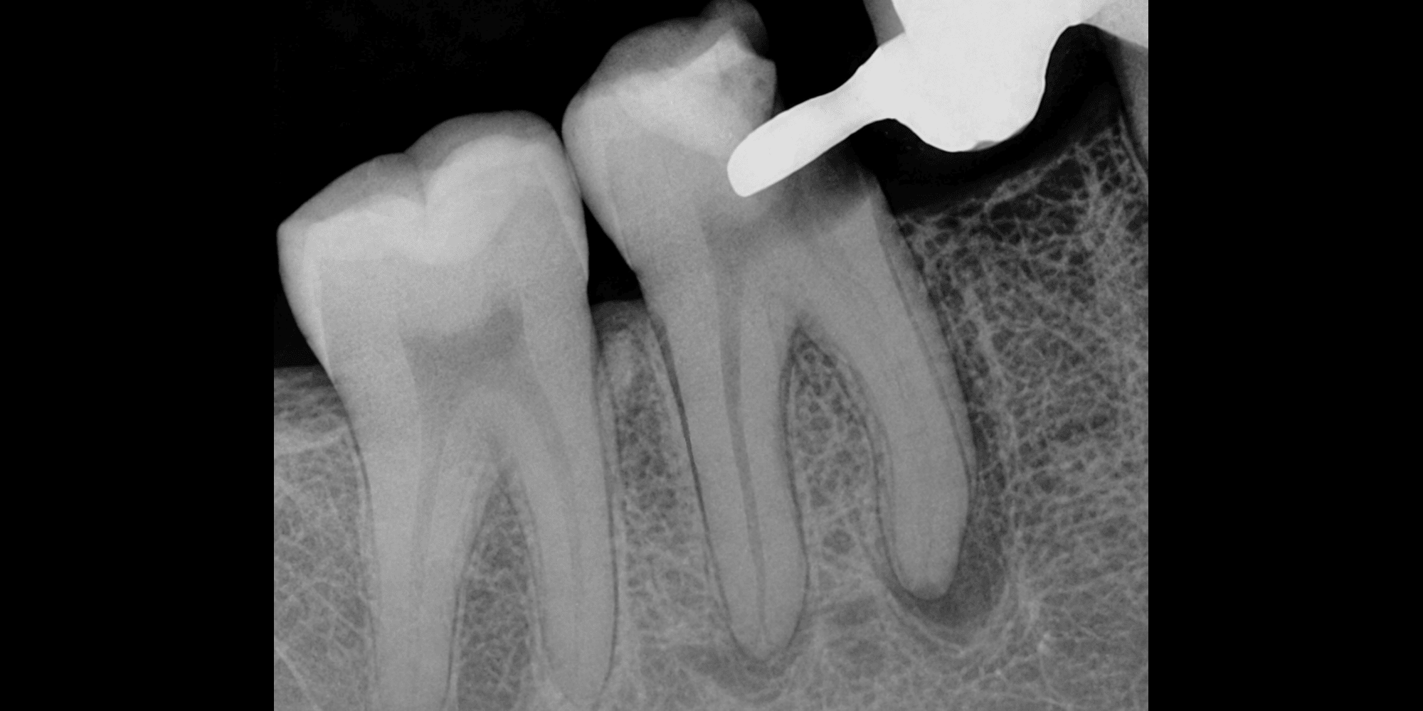 Root canal treatment before treatment