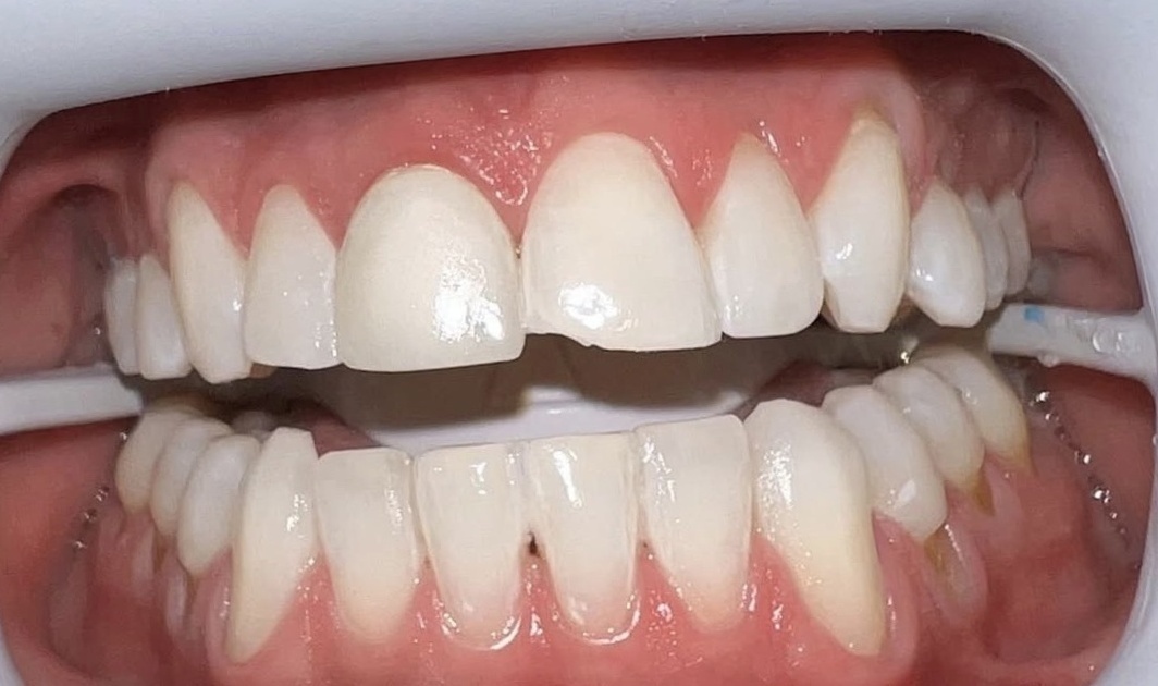Teeth whitening after treatment