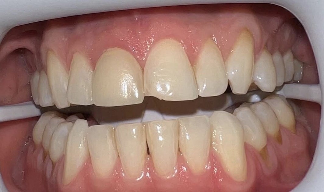 Teeth whitening before treatment